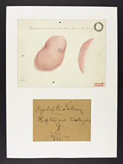 Cyst: Kidney: Rupture and Cicatrisation of a Serous Cyst