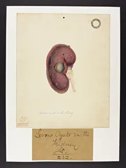 1827: Kidney: Serous Cysts