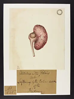 Pelvis: Kidney: Softening of Cortical Substance