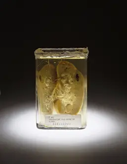 Forensic: Kidney, Stab Wound, 1937
