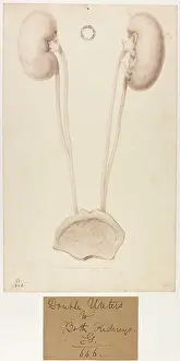 Kidneys: Both Kidneys with Double Ureters