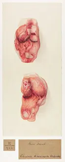 Knee: Knee Joint: Chronic Rheumatism