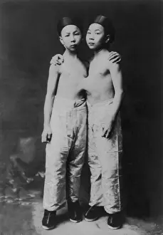 Deformity: Korean Siamese twins standing with hands ?