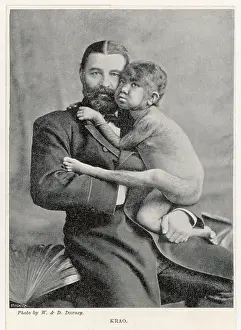 Hypertrichosis: KRAO THE HAIRY GIRL