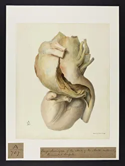 Laminated: Large Aneurysm of Arch of Aorta Containing Laminated Coagula