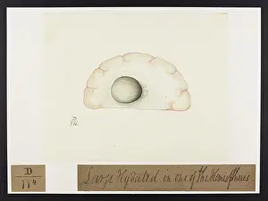 Hemisphere: Large Hydatid Situated in the Brain