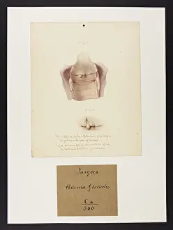 1831: Larynx: Oedema Glottidis