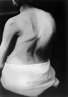 Bartholomew: Lateral Curvature of the Spine