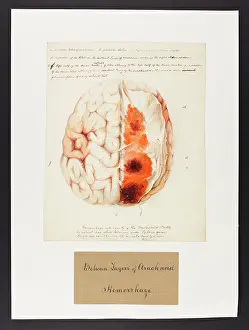 Layers: Between Layers of Arachnoid: Haemorrhage