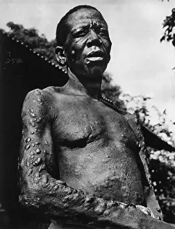 Leprosy: Leprosy