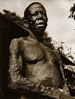 Color Enhanced: Leprosy