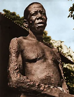 Colorization: Leprosy
