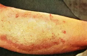 Lichen: Lichen Simplex Chronicus