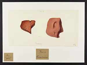 1831: Liver: Cicatrices