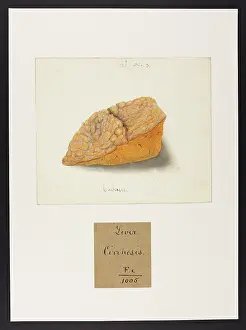 Liver: Liver: Cirrhosis