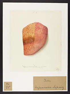 1831: Liver: Inflammation and Softening