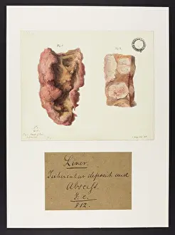 Liver: Liver: Tubercular Deposit and Abscesses