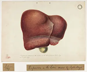 Liver: Longitudinal Depression in the Substance of the Liver