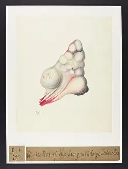 Lung: Lung with Tubercles