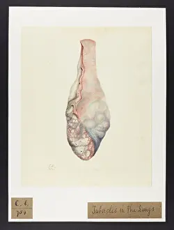 Lungs: Lung with Tubercles