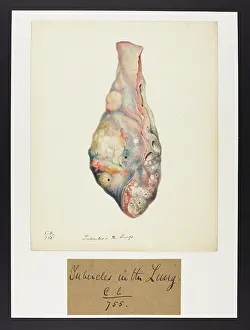 Lung: Lung with Tubercles