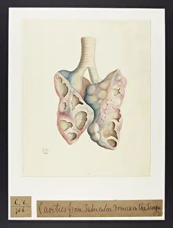 Lungs: Lungs with Tubercular Vomicae
