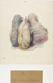 Hopital: Malformation of Pericardium