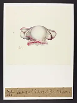 Ulcer: Malignant Ulcer of Uterus