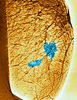 Tumor: Mammogram