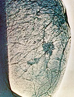 Tumor: Mammogram
