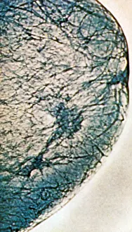 Tumor: Mammogram
