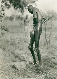 Lymphatic: A man Mann - suffering from Elefantiasis (Lymphatic