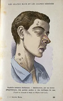 Grands: Man suffering from tertiary Syphilis. From Jules