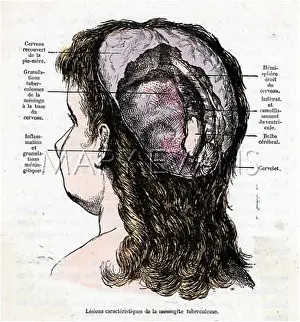 Meningitis: MANINGITIS SUFFERER