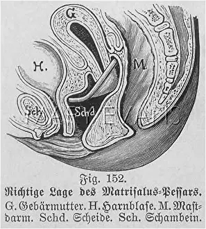 Uterus: MATRISALUS CAP/1905
