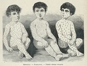 Measles: Measles Compared