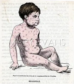 Measles: A MEASLES SUFFERER