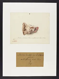 Filled: Meatus Auditorius Externus