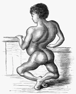 Deformation: MEDICAL/AILMENTS/RICKETS