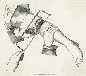Amputation: MEDICAL/SURGERY/AMPUTATI