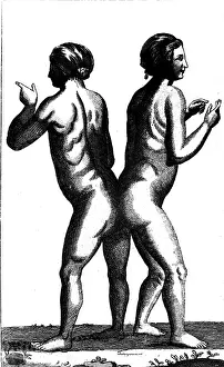 Defects: medicine, anomalies, Siamese twins, copper engraving