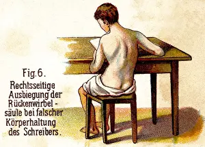 Cramped: medicine, warped spine as a result of wrong posture