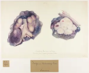 Vein: Medullary: Sarcoma of Lungs and Pulmonary Vein