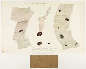 Dieu: Melanosis of Intestines
