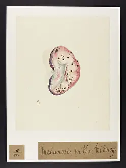 Melanosis: Melanosis in the Kidney