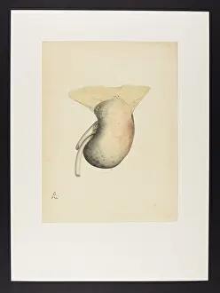 Melanosis: Melanosis of the Kidney