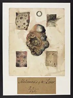 Liver: Melanosis of the Liver