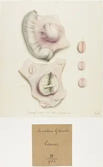 1831: Mesenteric Glands: Cancer