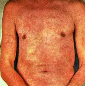 Prickly: Miliaria