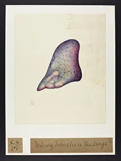 Lungs: Miliary Tubercles in Lungs